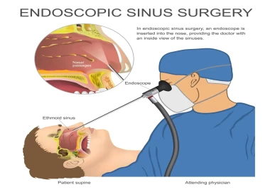 Sinus Surgery